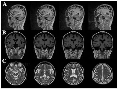 Case analysis of early-onset Alzheimer's disease associated with TBK1 p.Tyr235Phe gene mutation